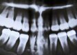 Is Wisdom Teeth Removal Covered By Medical Or Dental Insurance