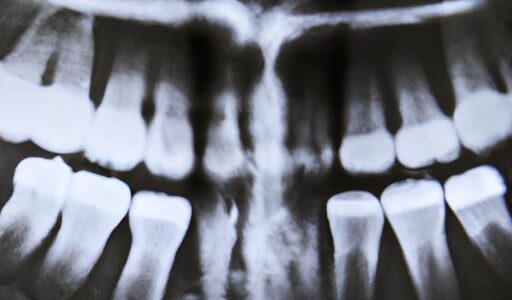 Is Wisdom Teeth Removal Covered By Medical Or Dental Insurance